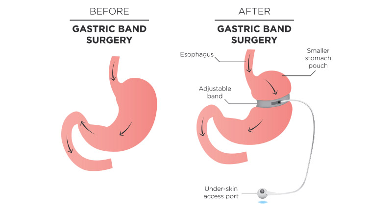 gastric band surgery weight loss surgery