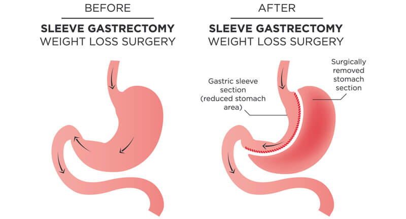 gastric sleeve gastrectomy weight loss surgery