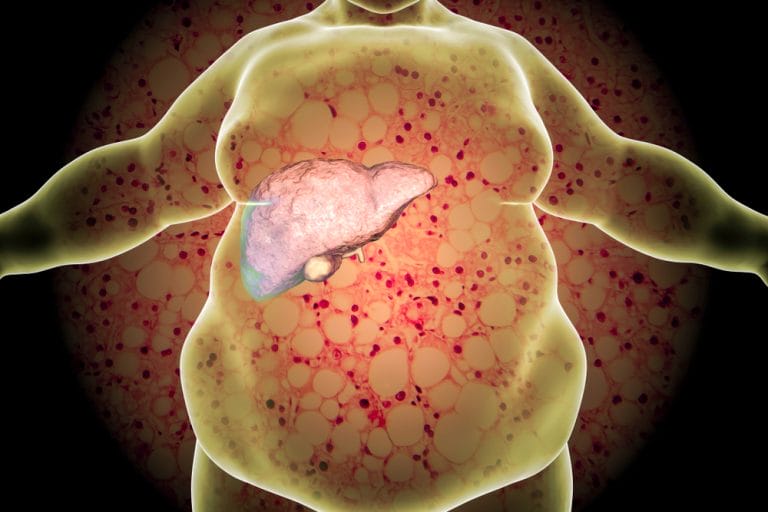Fatty Liver: What Is It and How Can It Affect Me?